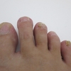 爪乾癬の初期症状：原因、診断、および治療法の概要