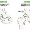 先天的大腿骨頭臼蓋形成不全