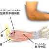 上腕骨外側上顆炎