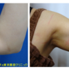 二の腕ボトックスで腕を細くします