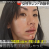 タレント・小島可奈子さんの顔を犬が“ガブリ”「傷跡が残ります」医師が断言…30針も縫う大けが