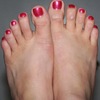 Hammer Toe Caused By Rheumatoid Arthritis