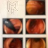 【その2】初めての大腸内視鏡検査