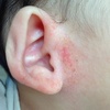 耳のじゅくじゅく