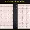 ECG-272：上肢の外傷で、入院した際の心電図です。