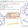 左心低形成症候群（HLHS:hypoplastic left heart syndrome）〜成り立ち　など　疾患17