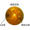 硬性白斑と軟性白斑の違い