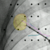 Augmented fluoroscopy [新しいNavigation toolとして活躍するか？] 