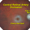 網膜中心動脈閉塞症でcherry red spotとなる理由