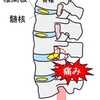 椎間板ヘルニアについて