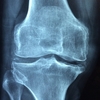 変形性膝関節症の保存的理学療法(実践編)