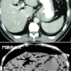 胆道気腫と門脈内ガスの区別