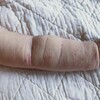 小児鍼によるアトピー治療｜谷中の『浩風堂』さんへ