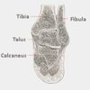 What Can Cause Inferior Calcaneal Spur