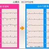 コラム-084：Low Voltageを悩まない、をUpToDate その２