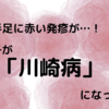 子供の手足に赤い発疹が…！【うちの子が川崎病になったお話】