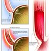 Acid Reflux And The Lungs