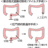 じじぃの「カオス・地球_270_すばらしい医学・すごい手術・器械で腸を切って縫う」