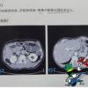 術後半年経過のCT検査、今のところ異常なし♪