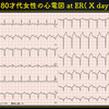 ECG-210：80才代女性。たこつぼの夜 ( a night in Takotubo Cardiomyopathy)