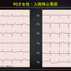 ECG-303：90才女性。入院中の頻拍発作です。