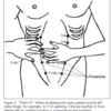  Lateral cutaneous nerve entrapment syndrome？？