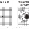 変視症