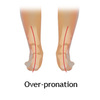 Over-Pronation Of The Feet What Are The Treatments