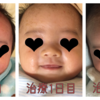 乳児湿疹とのバトル 〜第1章 脂漏性湿疹〜