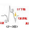 【１１２回医師国家試験】虚血性心疾患【循環器】