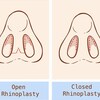 Difference between Open Rhinoplasty and Closed Rhinoplasty