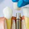 What to Expect After Dental Implant Surgery?