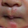 赤ちゃんの鼻の下の湿疹の治し方と予防方法！拭き方とファムズベビーで治せる