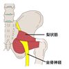 坐骨神経痛の治療