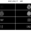 前交通動脈に動脈瘤を疑う所見(画像3矢印)を認めます