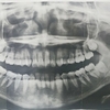 埋没親知らず４本同時に抜歯したよ