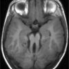 Joubert症候群のmolar tooth signがまんまな件