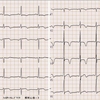 ECG-188：80才代女性。収縮期雑音 Leivine-III/VIです。