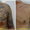 胸から腕のサルの黒いタトゥーを消しています。