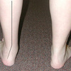 Posterior Tibial Tendon Dysfunction Surgery
