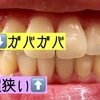 《221日目》下の歯への疑問《23/30枚》