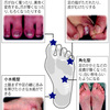 水虫、かゆくなる前に受診