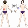 「腰が張って痛い」という不調で、ときどきある身過ごされがちなケース。肘の問題。