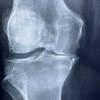変形性膝関節症の痛みの原因はどこ？トリガーポイント療法で痛みは改善できるか？