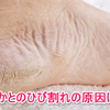 かかとのひび割れ！原因や治し方は？
