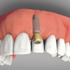 Có nên trồng răng implant cho răng đã mất không?