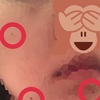 (2)ホクロを除去してきたよ(Qスイッチレーザー編)