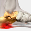 Controlling Posterior Calcaneal Spur