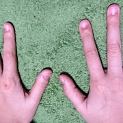 深爪はどうしたら治る 爪をむしる癖のある娘との付き合い方を考える 皮膚むしり症 自傷皮膚症 対処法まとめ 3人子育て転妻ブログ 深爪はどうしたら治る 爪をむしる癖のある娘との付き合い方を考える 皮膚むしり症 自傷皮膚症 対処法まとめ 3人子育て転妻ブログ