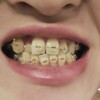 矯正前と後の歯並びを比較してみる